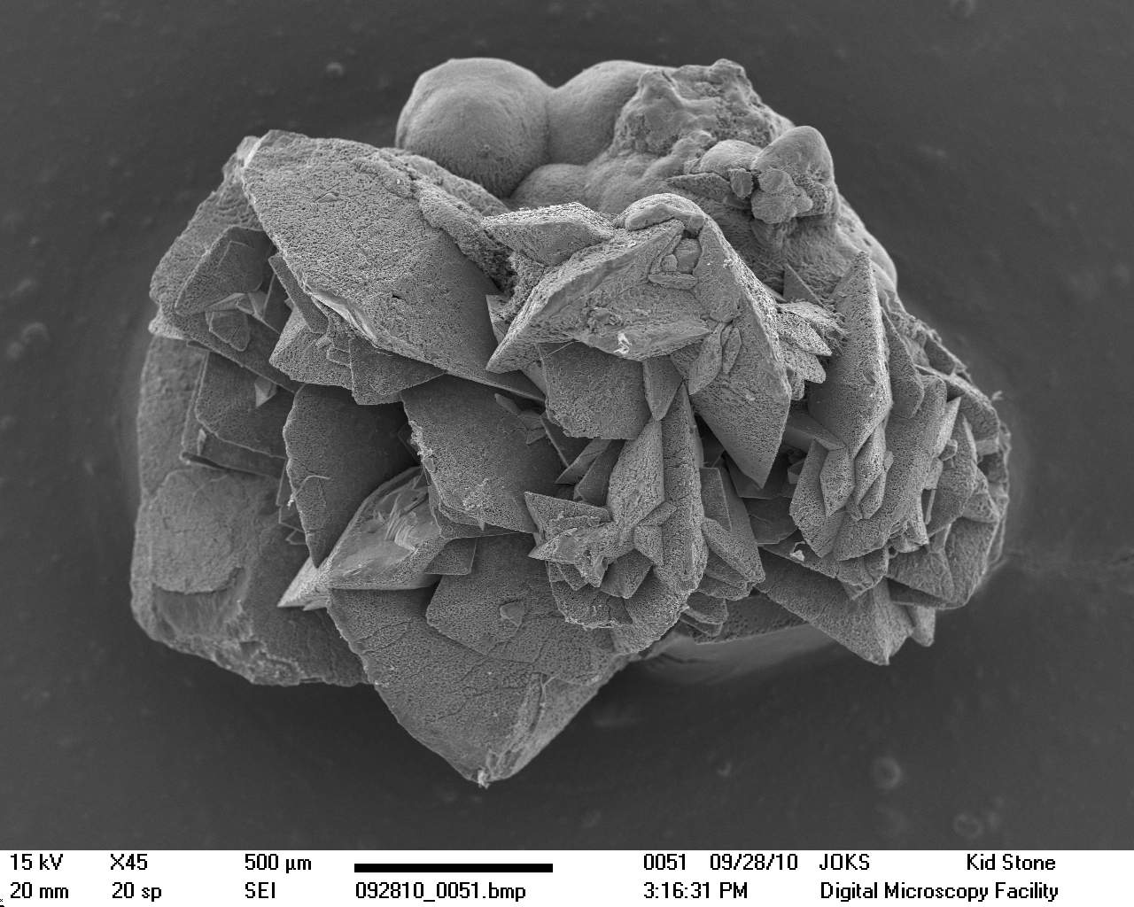 SEM kidney stone